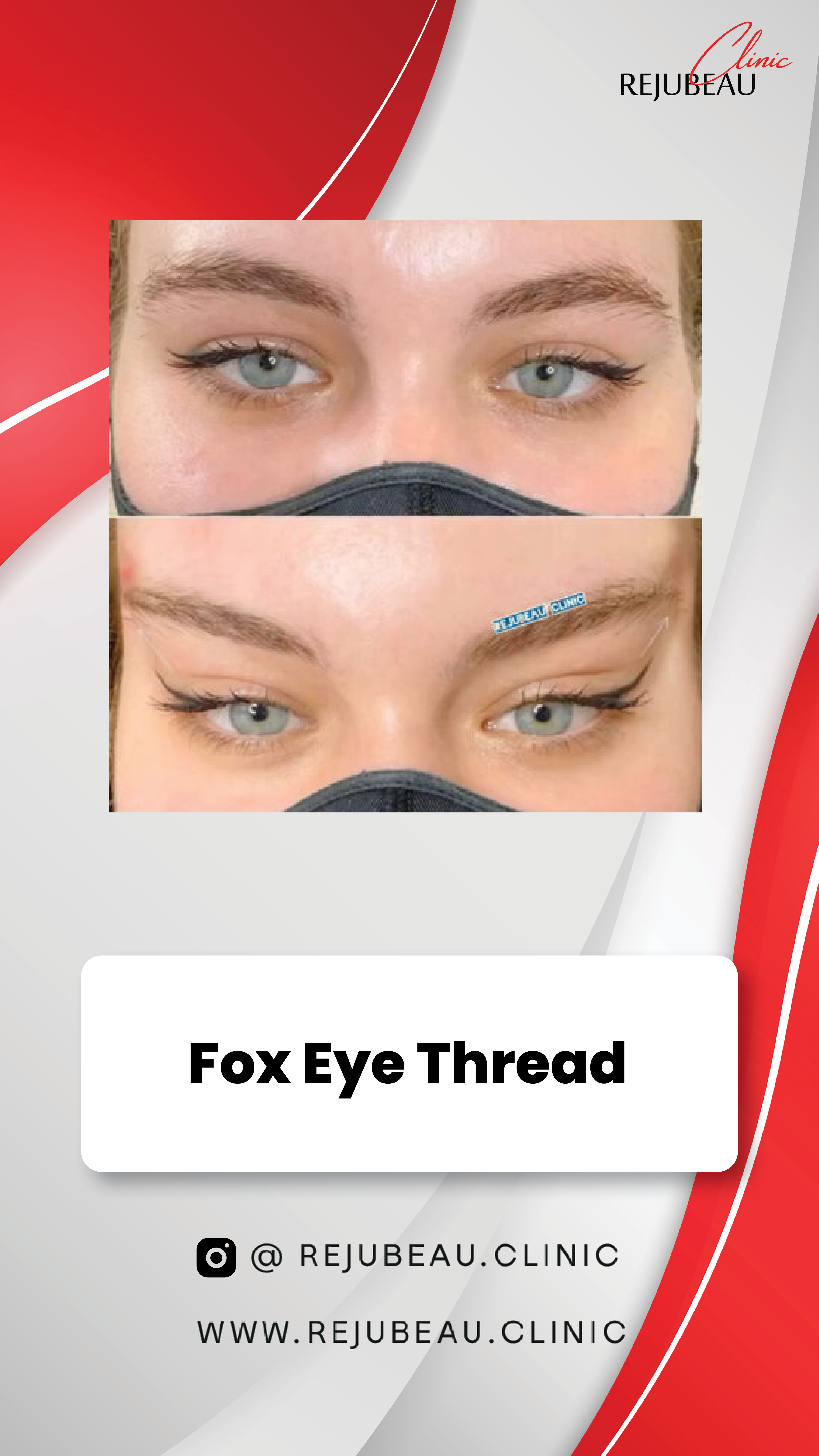 Face lift with threads