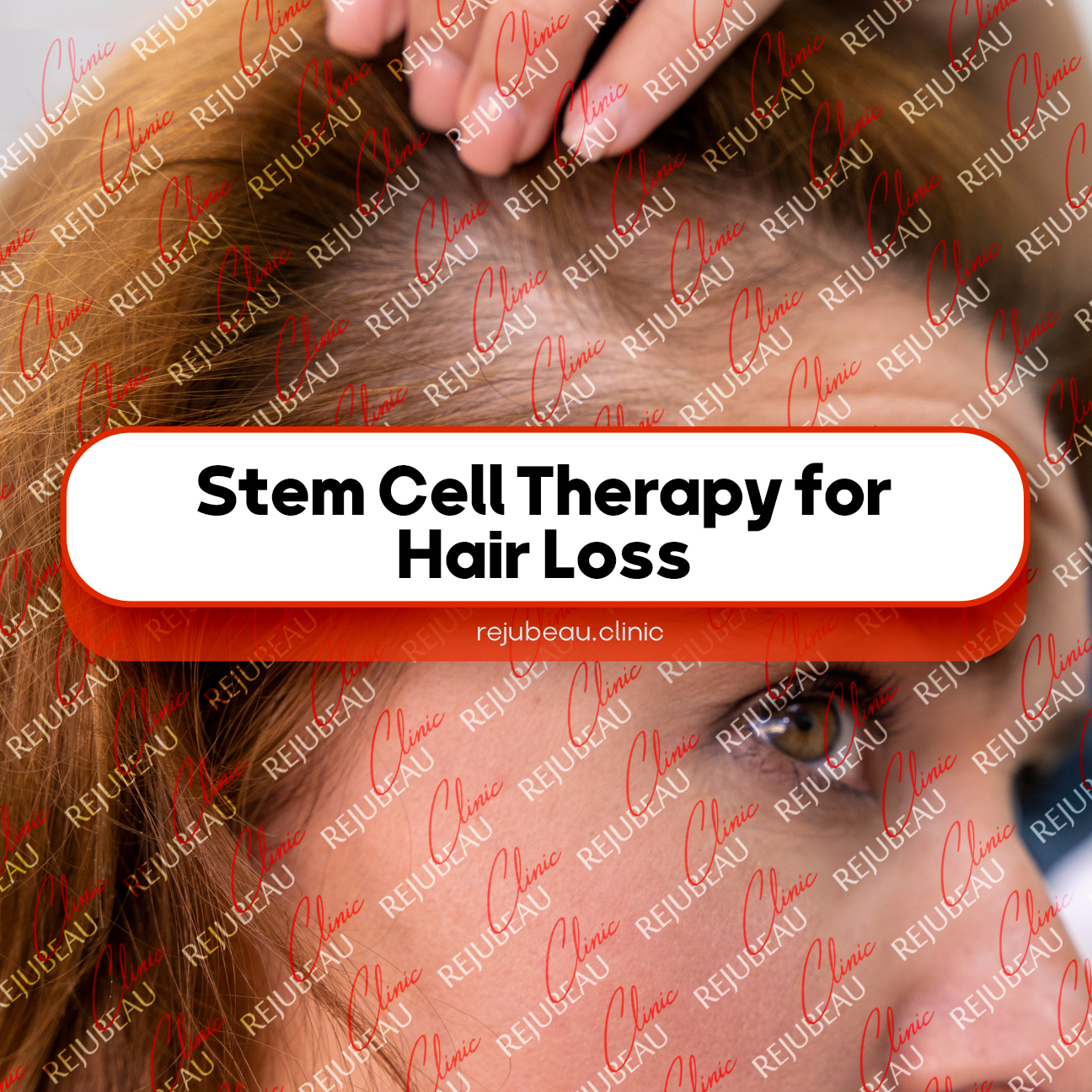Stem Cell Therapy for Hair Loss