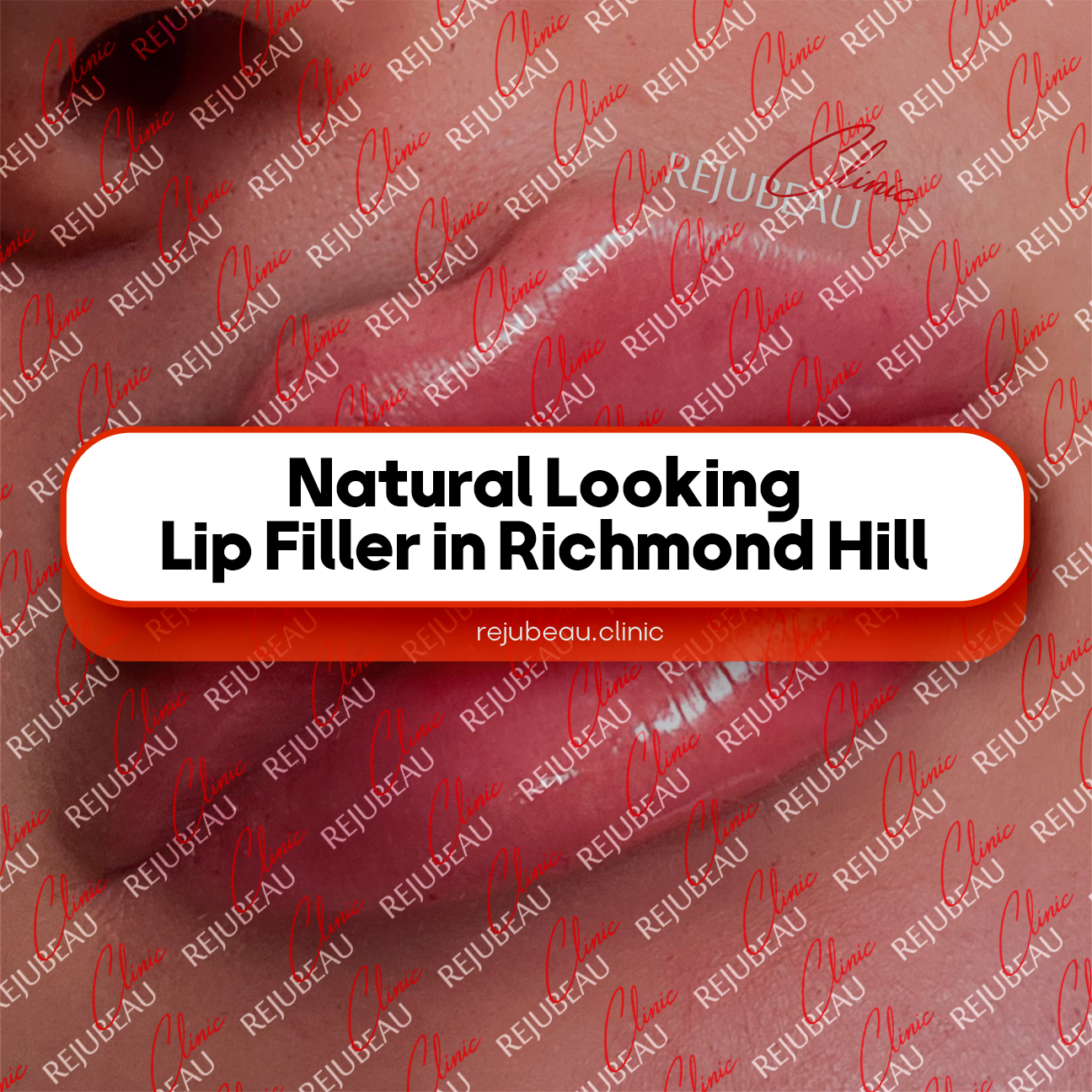 Natural-Looking-Lip-Filler-in-Richmond-Hill
